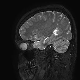 Cerebral arteriovenous malformation at posterior body of corpus callosum (Radiopaedia 74111-84925 Sagittal T2 97).jpg