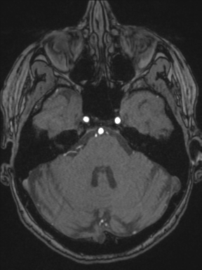 Cerebral arteriovenous malformation with hemorrhage (Radiopaedia 34422-35737 Axial MRA 20).png