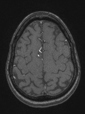Cerebral arteriovenous malformation with hemorrhage (Radiopaedia 34422-35737 Axial MRA 69).png