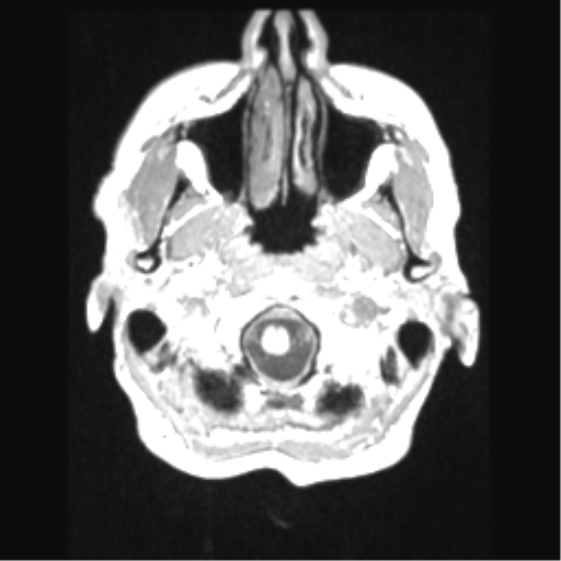 File:Cerebral arteriovenous malformation with hemorrhage (Radiopaedia 34422-35737 Axial T1 7).png