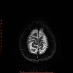 File:Cerebral cavernous malformation (Radiopaedia 26177-26306 Axial DWI 40).jpg