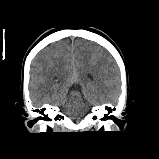 Cerebral cavernous venous malformation (Radiopaedia 70008-80022 non-contrast 45).jpg