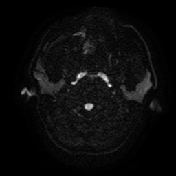 Cerebral cavernous venous malformation (Zabramski type II) (Radiopaedia 85511-101198 Axial DWI 35).jpg