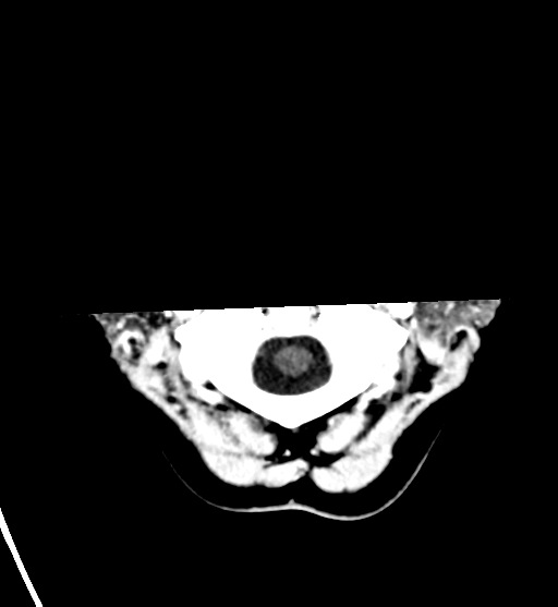 File:Cerebral cavernous venous malformations (Radiopaedia 48117-52945 Axial C+ delayed 3).png