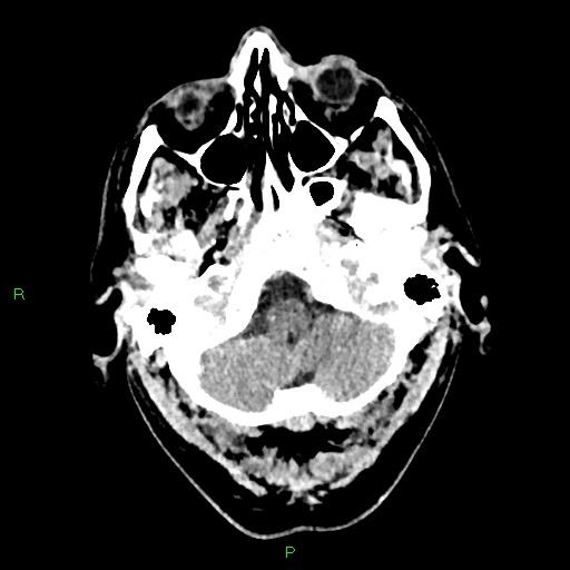 Cerebral contusions (Radiopaedia 33868-35039 Axial non-contrast 25).jpg