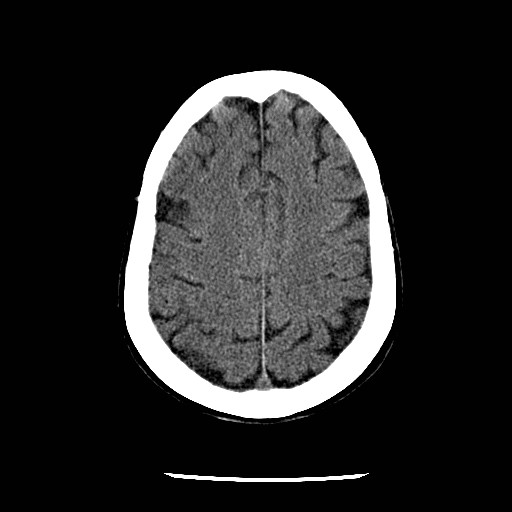 Cerebral edema (evolution in time) (Radiopaedia 19418-19441 non-contrast 71).jpg