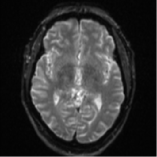 File:Cerebral embolic infarcts (embolic shower) (Radiopaedia 57395-64342 Axial DWI 17).png