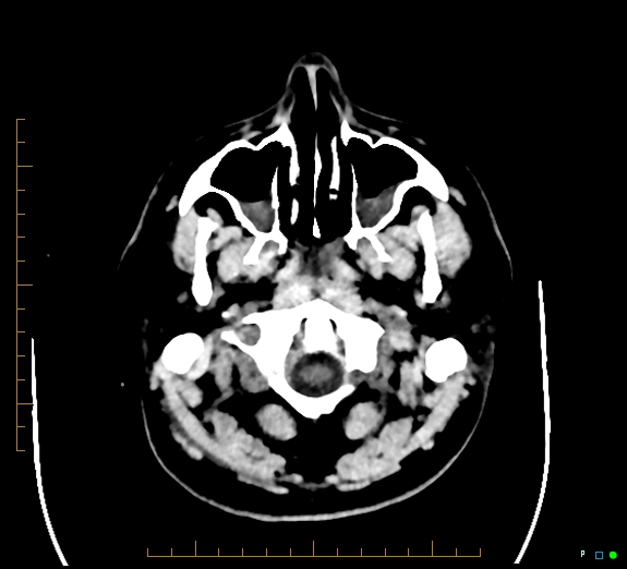 Cerebral fat embolism (Radiopaedia 85521-101220 Axial non-contrast 9).jpg