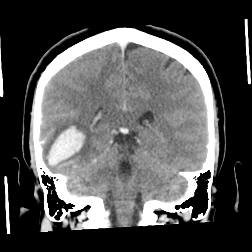 Cerebral hemorrhage secondary to arteriovenous malformation (Radiopaedia 33497-34561 C 43).png