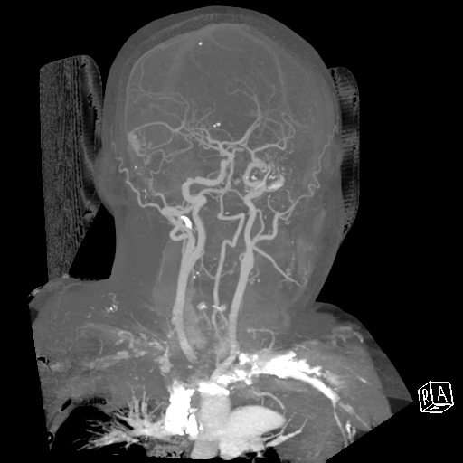 File:Cerebral hemorrhage secondary to arteriovenous malformation (Radiopaedia 33497-34571 A 23).png