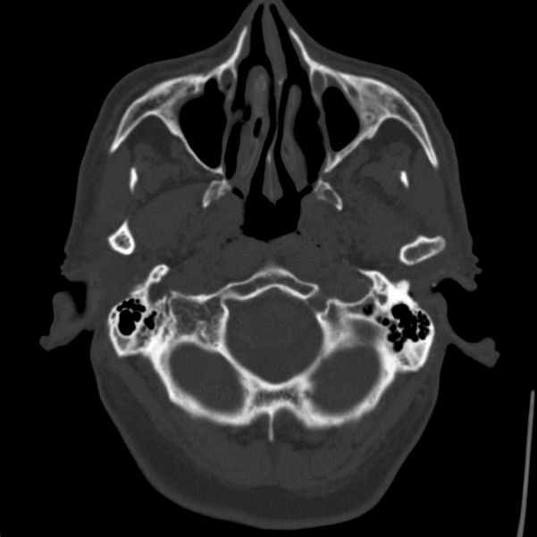 Cerebral hemorrhagic contusions (Radiopaedia 23145-23188 Axial bone window 6).jpg