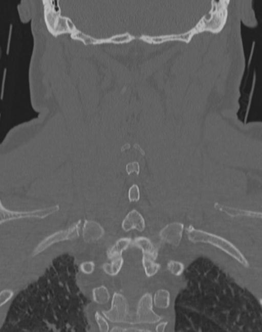 Cerebral hemorrhagic contusions and cervical spine fractures (Radiopaedia 32865-33841 Coronal bone window 55).jpg