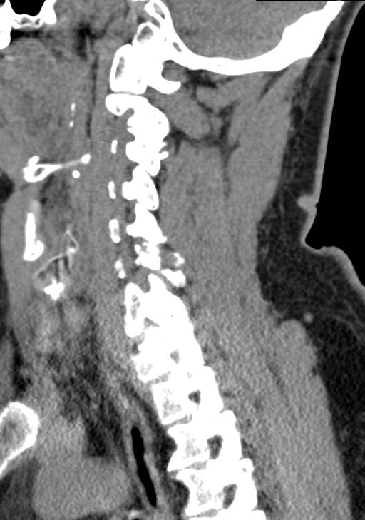 Cerebral hemorrhagic contusions and cervical spine fractures (Radiopaedia 32865-33841 G 48).jpg