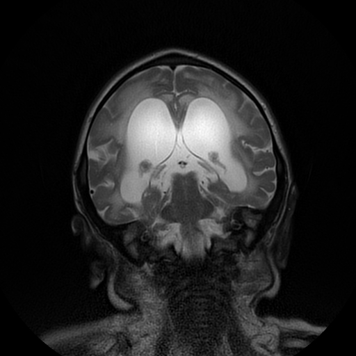 File:Cerebral manifestations of mucopolysaccharidosis type I (Radiopaedia 59171-66487 Coronal T2 13).jpg