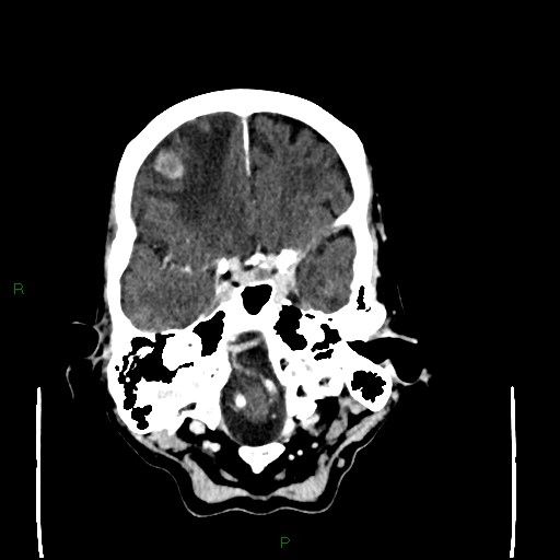 Cerebral metastases - breast primary (Radiopaedia 77653-89857 Axial C+ delayed 30).jpg