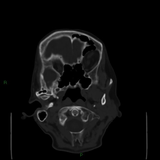 Cerebral metastases - breast primary (Radiopaedia 77653-89857 Axial bone window 16).jpg
