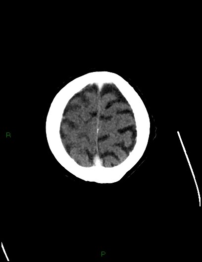 File:Cerebral metastases - ependymal and parenchymal (Radiopaedia 79877-93131 Axial C+ delayed 75).jpg