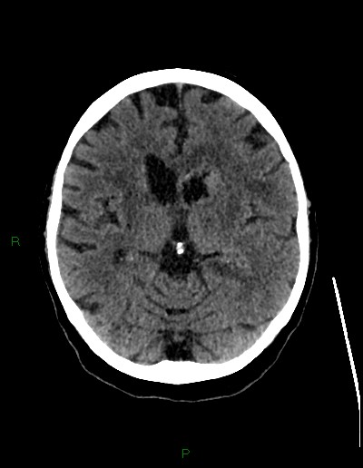 Cerebral metastases - ependymal and parenchymal (Radiopaedia 79877-93131 Axial non-contrast 37).jpg