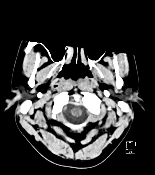 Cerebral metastases - testicular choriocarcinoma (Radiopaedia 84486-99855 Axial non-contrast 51).jpg