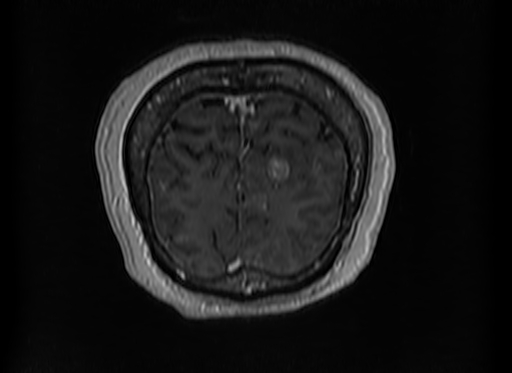 Cerebral metastases from lung cancer with amyloid angiopathy and cerebellopontine angle meningioma (Radiopaedia 74306-85191 Coronal T1 C+ 56).jpg