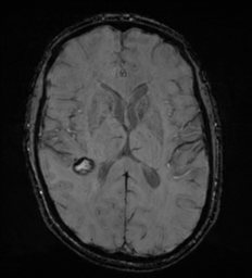 File:Cerebral metastasis - melanoma (Radiopaedia 54718-60954 Axial SWI 31).png