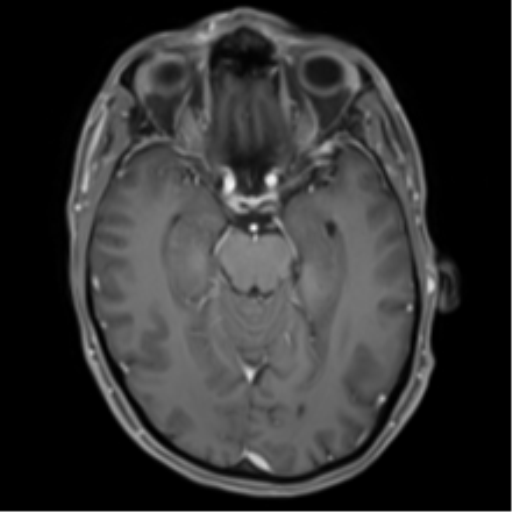 Cerebral metastasis - melanoma (Radiopaedia 54718-60954 Axial T1 C+ fat sat 21).png