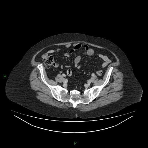 File:Cerebral metastasis from renal cell carcinoma (Radiopaedia 82306-96378 A 144).jpg