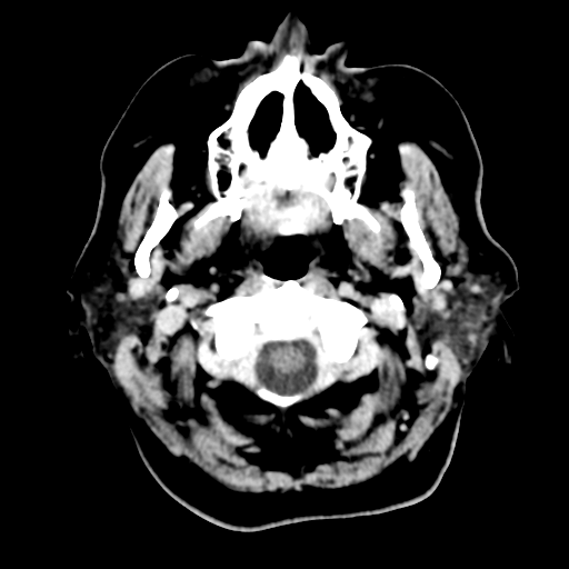 Cerebral metastasis to basal ganglia (Radiopaedia 81568-95412 Axial C+ delayed 7).png