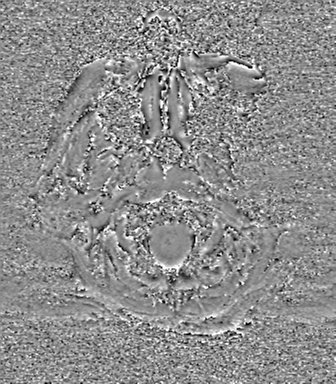 Cerebral metastasis to basal ganglia (Radiopaedia 81568-95413 Axial SWI phase 1).png