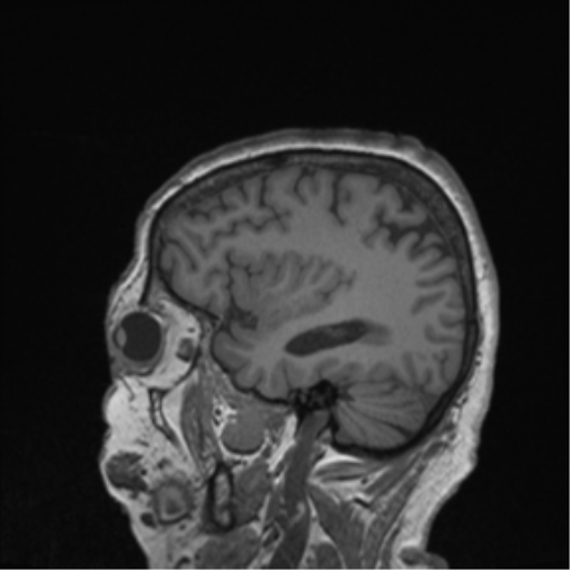 Cerebral metastasis to basal ganglia (Radiopaedia 81568-95413 Sagittal T1 16).png