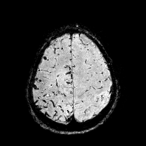 Cerebral parenchymal arteriovenous malformation (Radiopaedia 27280-27456 Axial SWI 100).jpg