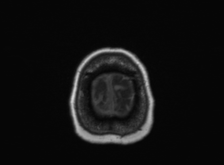 Cerebral ring enhancing lesions - cerebral metastases (Radiopaedia 44922-48817 Axial T1 105).jpg