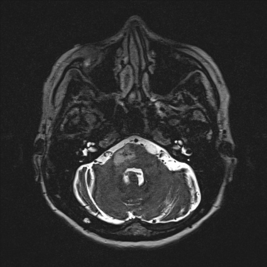 Cerebral ring enhancing lesions - cerebral metastases (Radiopaedia 44922-48817 F 30).jpg
