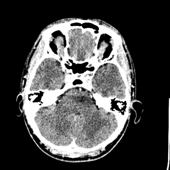 Cerebral toxoplasmosis (Radiopaedia 53993-60131 Axial C+ delayed 20).jpg