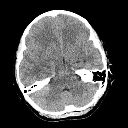 Cerebral tuberculosis with dural sinus invasion (Radiopaedia 60353-68018 Axial non-contrast 17).jpg