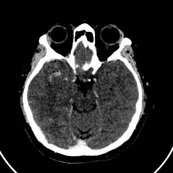 Cerebral venous hemorrhagic infarct from venous sinus thrombosis (Radiopaedia 55433-61883 Axial C+ delayed 95).jpg