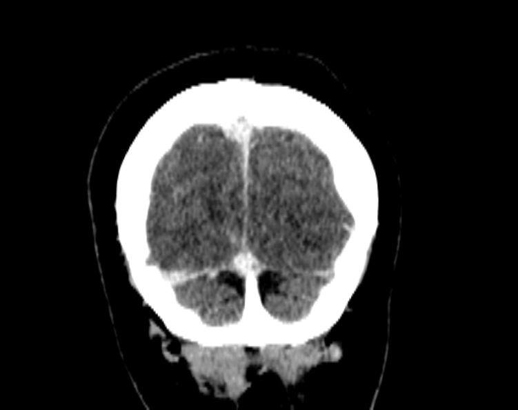 Cerebral venous hemorrhagic infarct from venous sinus thrombosis (Radiopaedia 55433-61883 Coronal C+ delayed 54).jpg