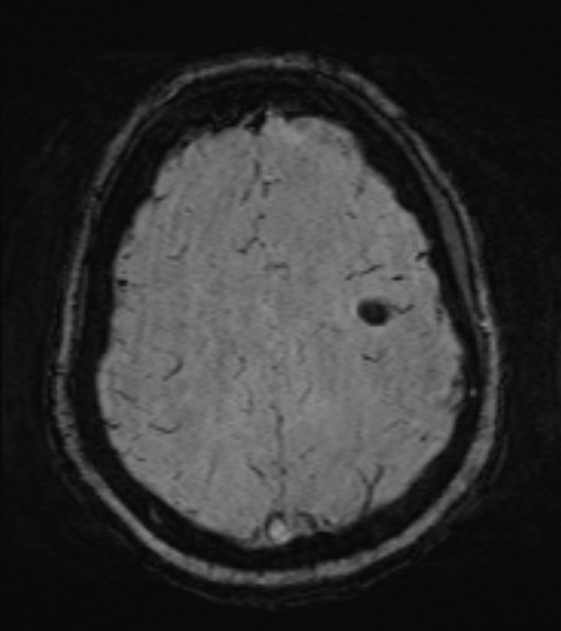 Cerebral venous infarct (Radiopaedia 53627-59685 Axial SWI 41).jpg