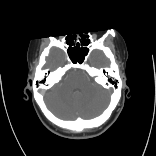 File:Cerebral venous infarct related to dural venous sinus thromboses (Radiopaedia 35292-36804 Axial C+ delayed 14).png