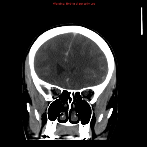 Cerebral venous infarction (Radiopaedia 12404-20735 B 24).jpg