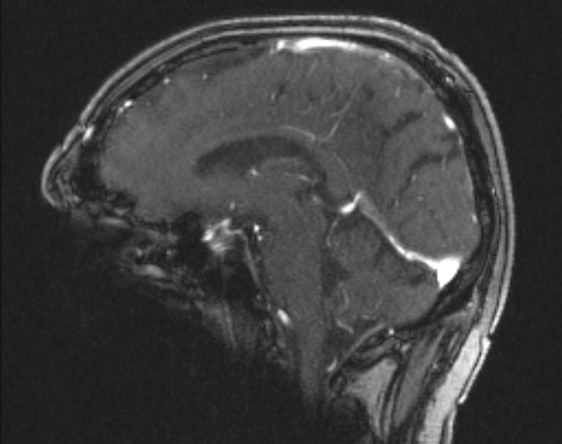 Cerebral venous infarction (Radiopaedia 65166-74176 Sagittal TOF 36).jpg
