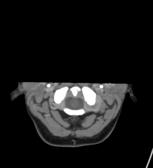File:Cerebral venous infarction due to transverse sinus thrombosis (Radiopaedia 34688-36120 Axial CT venogram 4).png