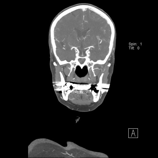Cerebral venous infarction with hemorrhage (Radiopaedia 65343-74396 B 133).jpg