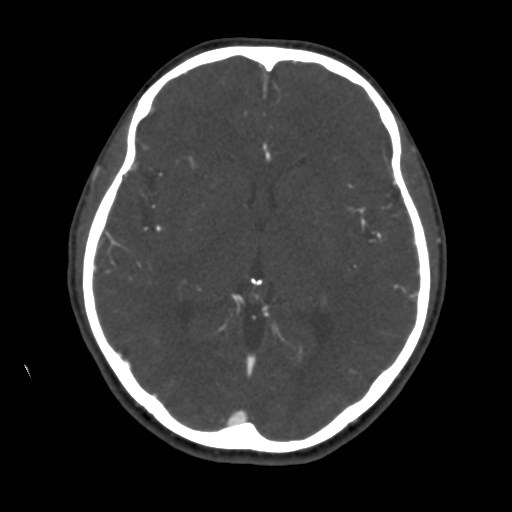 Cerebral venous sinus thrombosis (Radiopaedia 40619-43227 A 113).jpg