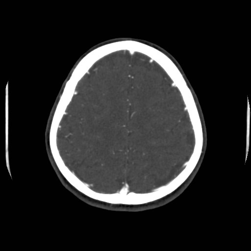 Cerebral venous sinus thrombosis (Radiopaedia 40619-43227 A 181).jpg
