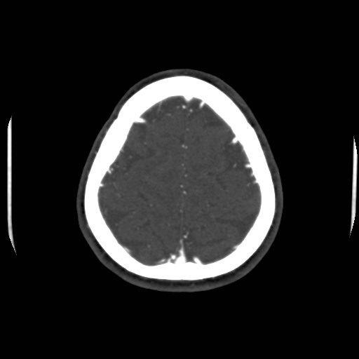 Cerebral venous sinus thrombosis (Radiopaedia 40619-43227 A 197).jpg