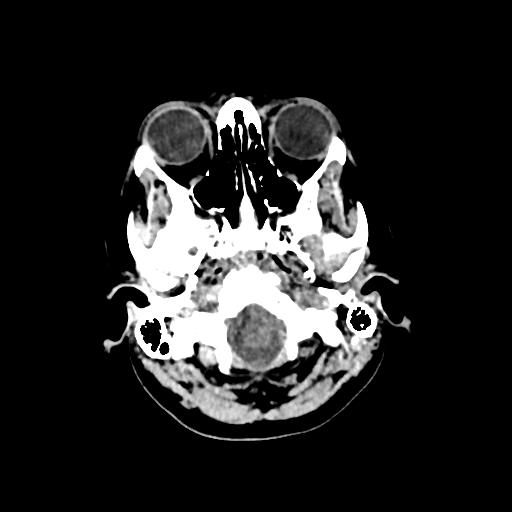 Cerebral venous throbmosis - hemorrhagic venous infarction (Radiopaedia 87318-103613 Axial non-contrast 17).jpg