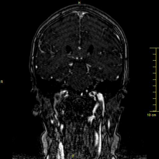 Cerebral venous thrombosis (Radiopaedia 23288-23351 MRV 94).JPG