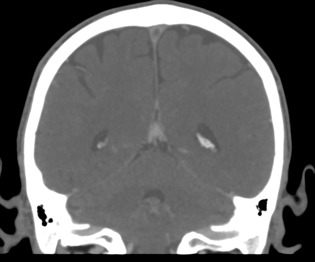File:Cerebral venous thrombosis (Radiopaedia 38392-40467 Coronal CTA-Venogram 43).png