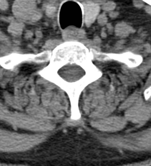 File:Cervical canal stenosis - OPLL and osteophytes (Radiopaedia 47329-51910 Axial non-contrast 53).png